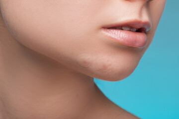 Obraz premium Girl with acne stick round acne patch on her cheek. Using acne patches for treatment of pimple and rosacea close-up. Facial rejuvenation cleansing cosmetology