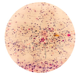 Photomicrographic exam of Paps Smear showing Inflammatory smear with vaginal candidiasis . Medical concept.