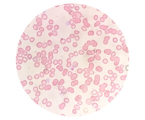Plasmodium vivax in thin film under microscopy, Malaria disease. P. vivax, Malaria parasite in red blood cells