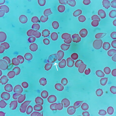 Plasmodium vivax in thin film under microscopy, Malaria disease. P. vivax, Malaria parasite in red blood cells