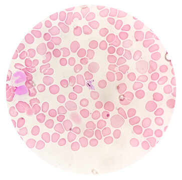 Plasmodium vivax in thin film under microscopy, Malaria disease. P. vivax, Malaria parasite in red blood cells