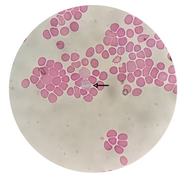 Plasmodium vivax in thin film under microscopy, Malaria disease. P. vivax, Malaria parasite in red blood cells