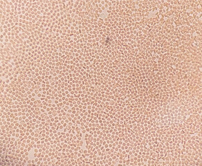 Photomicrograph of Sickle cell anemia, sickling test. Sickle cell disease (SCD)