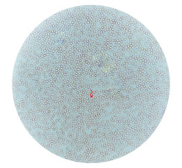 Photomicrograph of Sickle cell anemia, sickling test. Sickle cell disease (SCD)