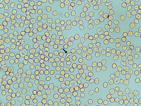 Photomicrograph of Sickle cell anemia, sickling test. Sickle cell disease (SCD)