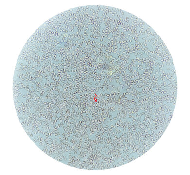 Photomicrograph of Sickle cell anemia, sickling test. Sickle cell disease (SCD)