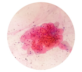 Photomicrograph of Paps smear showing Mild dysplasia (LSIL)