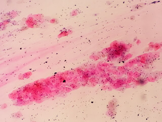 Photomicrograph of Paps smear showing Mild dysplasia (LSIL)