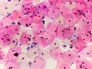 Photomicrograph of Paps smear showing Mild dysplasia (LSIL)