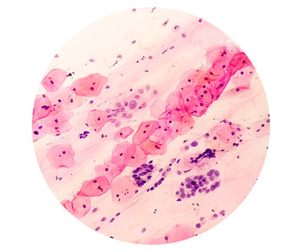 Photomicrograph of Paps smear showing Mild dysplasia (LSIL)