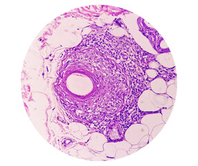 Photomicrograph of Skin tissue biopsy showing Lichen planus. T-cell mediated autoimmune disorder.