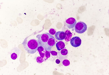 Microscopic view of bone marrow slide showing Multiple myeloma, a type of bone marrow cancer.