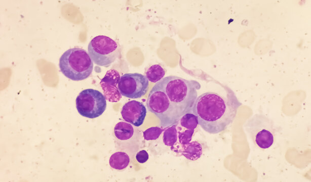 Microscopic view of bone marrow slide showing Multiple myeloma, a type of bone marrow cancer.