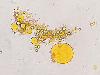 Microscopic stool analysis showing Neutral fat. fecal fat globules. Enteric infections, impaired...