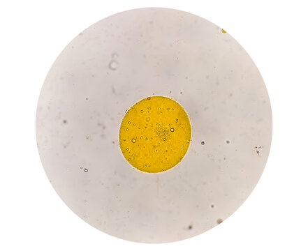 Microscopic stool analysis showing Neutral fat. fecal fat globules. Enteric infections, impaired digestion, loss of villous cells and poor fat absorption can lead neutral fat in stool.