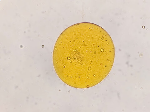Microscopic stool analysis showing Neutral fat. fecal fat globules. Enteric infections, impaired digestion, loss of villous cells and poor fat absorption can lead neutral fat in stool.