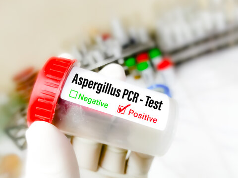 Scientist holding sample for Aspergillus PCR testing, 