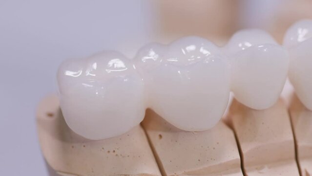 Zirconium crowns. Ceramic teeth with the implant on a plaster model isolated on a white background. Ceramic bridge on plaster model