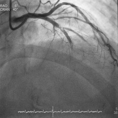 Coronary angiogram (CAG) was performed total occlusion at left anterior descending artery (LAD).