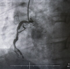 Coronary angiogram (CAG) was performed total occlusion at right coronary artery (RCA).