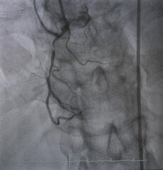 Coronary angiogram (CAG) was performed right coronary artery (RCA) stenosis.