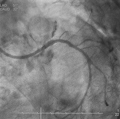 Coronary angiogram (CAG) was performed chronic total occlusion (CTO) at left anterior descending...