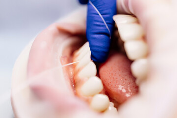 Close-up of flossing teeth. Dentistry, oral hygiene and dental treatment.