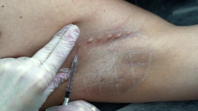 A doctor injects Botox into a patient's armpit to reduce sweating. The concept of beauty and modern technologies.