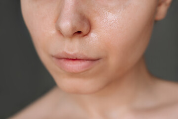 Cropped shot of a young caucasian woman with greasy skin on her skin on a dark background....