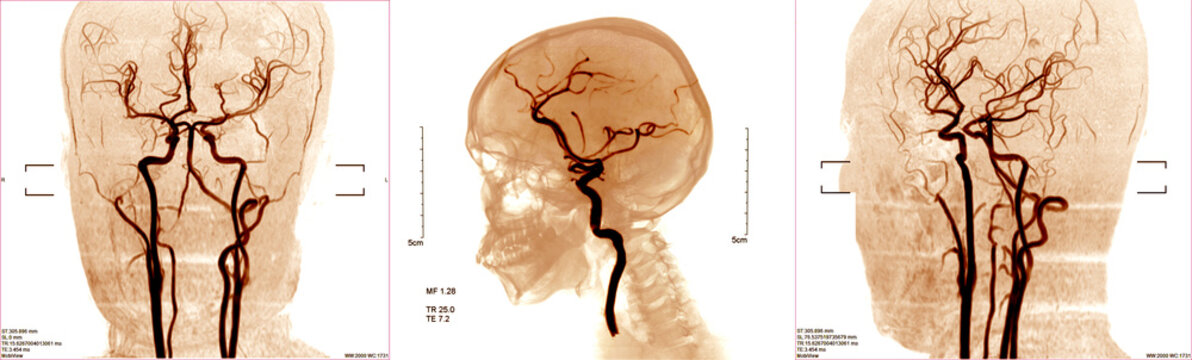 blood vessels x-ray images in the brain for diagnose cerebrovascular disease or hemorrhagic stroke.