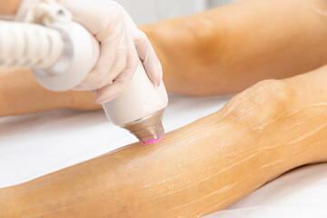 Diode laser epilation hair removal procedure on a woman leg. Beautician doing laser rejuvenation in...