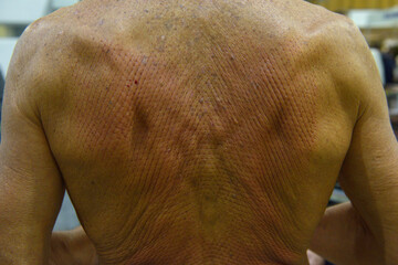 Naklejka premium Punctured back of an old man just after massage with acupuncture mat