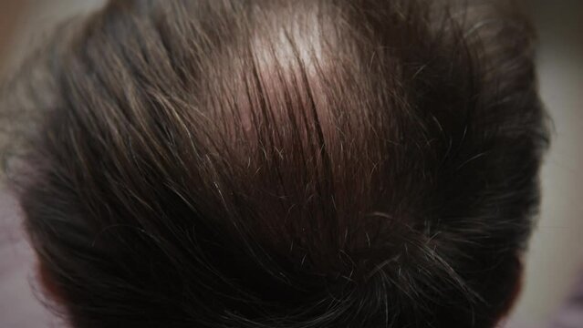 Close-up top view of balding male head, brunette man with hair loss problem combs his head with black comb