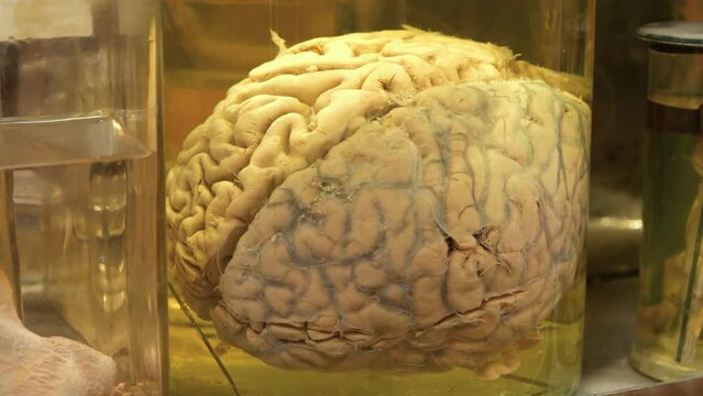 Real human brain. Anatomy of the brain. Human brain in glass jar with formaldehyde for medical research