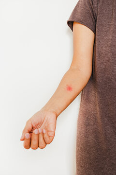 Shingles, Zoster or Herpes Zoster symptoms on womans arm isolated.