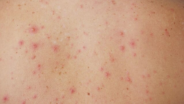 Back of adult have spotted, red pimple and bubble rash from chickenpox or varicella zoster virus