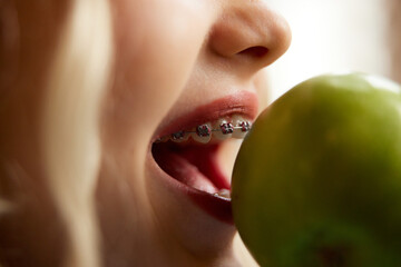 Side view. Extreme close up shot. Cropped photo of woman with dental braces bites fresh, green apple. Concept of youth and healthcare, medicine and beauty, confidence and selfcare.