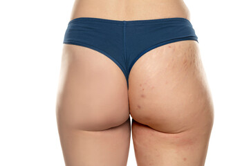 Comparison before and after woman's buttocks with stretch marks removal treatment on a white background