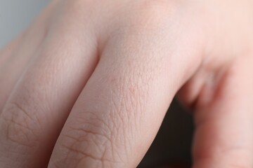 Woman with dry skin on hand, closeup