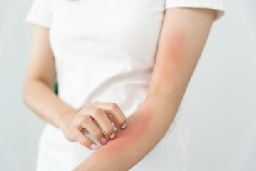 skin problem and beauty. Young woman scratch body has itchy skin from skin allergic, steroid...