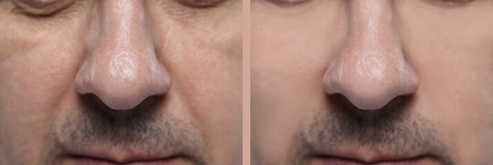 Aging skin changes. Man showing face before and after rejuvenation, closeup. Collage comparing skin...