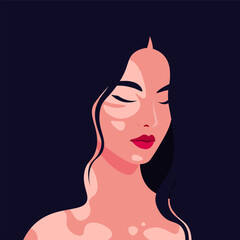 The face of a young Asian woman is half turned with vitiligo depigmentation on a dark background. Portrait of teenager. Vector flat Illustration