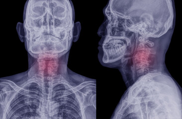 X-ray of the cervical spine to diagnose lateral deformity. The anterior side shows abnormalities of...