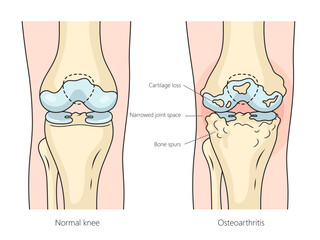 Human Osteoarthritis Rheumatoid arthritis of knee joint structure diagram hand drawn schematic vector illustration. Medical science educational illustration