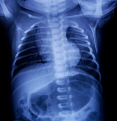 Pneumonitis of baby patient(bilateral), CXR (Chest X-Ray) AP view. Lungs ill defined opacities are...