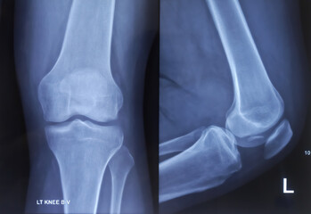 X-ray of knee joint AP and lateral view. Small fracture fragment-possibly arising from lateral...