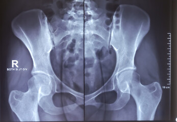 X-ray image of female pelvic. Scleroses are noted at the articular margins of both SI joints. - obrazy, fototapety, plakaty