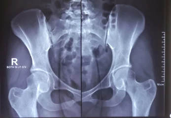 Fotobehang X-ray image of female pelvic. Scleroses are noted at the articular margins of both SI joints. © MdBabul