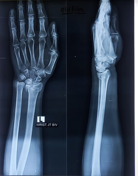 X-ray image of Wrist joint both view. Comminuted fracture is noted at the lower end of radius.