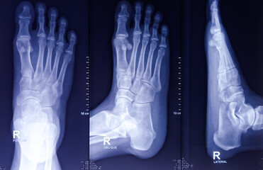 X-ray of foot both view. Fracture is noted at proximal phalanx on 4th toe. Soft tissue swelling.